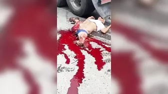 A Man Had Both His Legs Blown Off After Being Hit By A Truck.