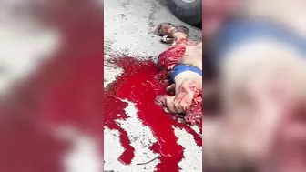 A Man Had Both His Legs Blown Off After Being Hit By A Truck.