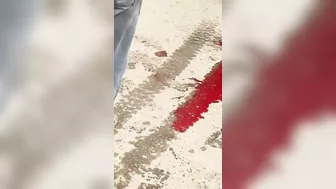 A Man Had Both His Legs Blown Off After Being Hit By A Truck.