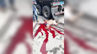 A Man Had Both His Legs Blown Off After Being Hit By A Truck.