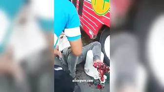 A Motorcyclist Who Suffered A Leg Injury In An Accident Received An S-point