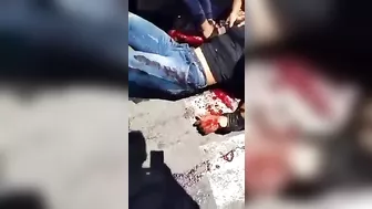 After The Accident, The Man's Arm Was Hanging On H.