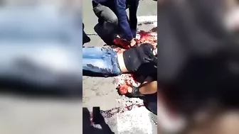 After The Accident, The Man's Arm Was Hanging On H.