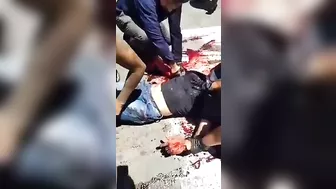 After The Accident, The Man's Arm Was Hanging On H.