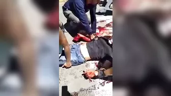 After The Accident, The Man's Arm Was Hanging On H.