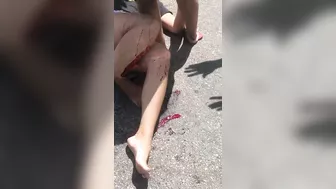 Woman Left With Only One Foot As A Result Of Accident