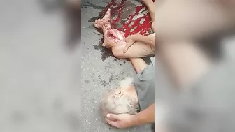 An Old Man's Leg Was Run Over By A Truck...luckily He Was Not Killed.