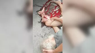 An Old Man's Leg Was Run Over By A Truck...luckily He Was Not Killed.