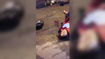 Two Motorcycles Collided, Woman's Legs Were Severely Shattered