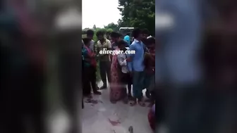 A Woman's Skull Burst Out Of Her Skin In An Accident In India