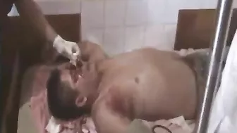 Motorcycle Accident In New Guinea