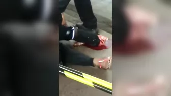 Her Foot Is Broken.