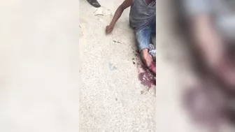 Shocked Man Tries To Sew Severed Leg Back Together