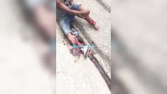 Shocked Man Tries To Sew Severed Leg Back Together
