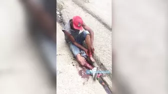 Shocked Man Tries To Sew Severed Leg Back Together