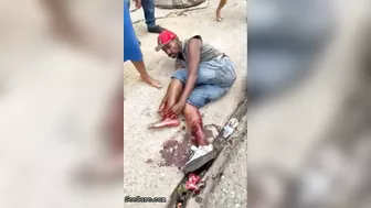 Man Tries To Sew Severed Leg Back Together